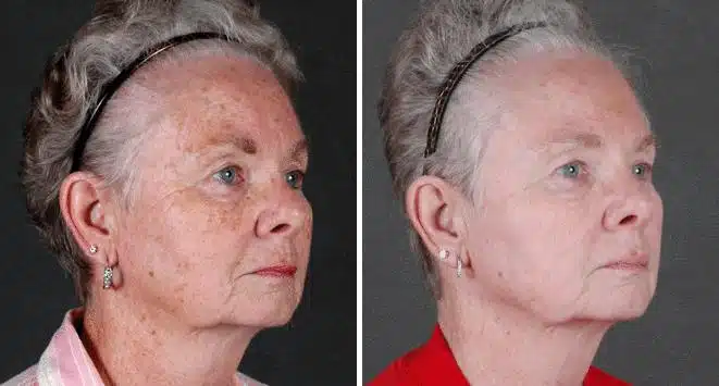 Obagi Skin Care Before and After Photos in Omaha, NE, Case 6104