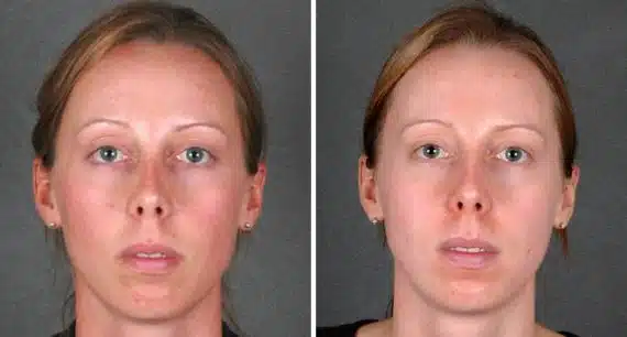 Obagi Skin Care Before and After Photos in Omaha, NE, Case 6111