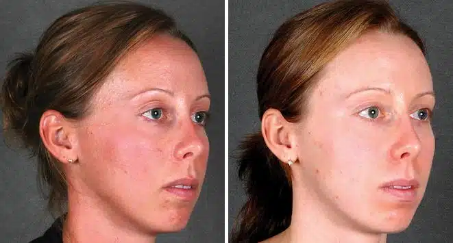 Obagi Skin Care Before and After Photos in Omaha, NE, Case 6111