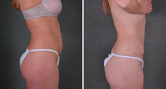 Tummy Tuck Before and After Photos in Omaha, NE, Case 7826