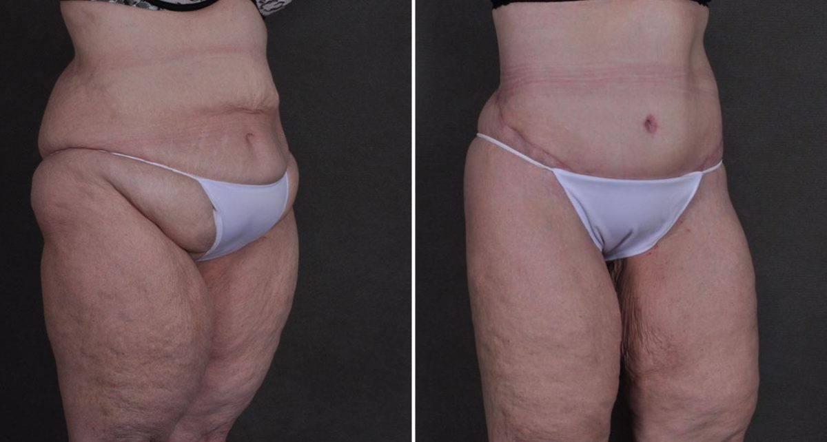 Tummy Tuck Before and After Photos in Omaha, NE, Case 8652