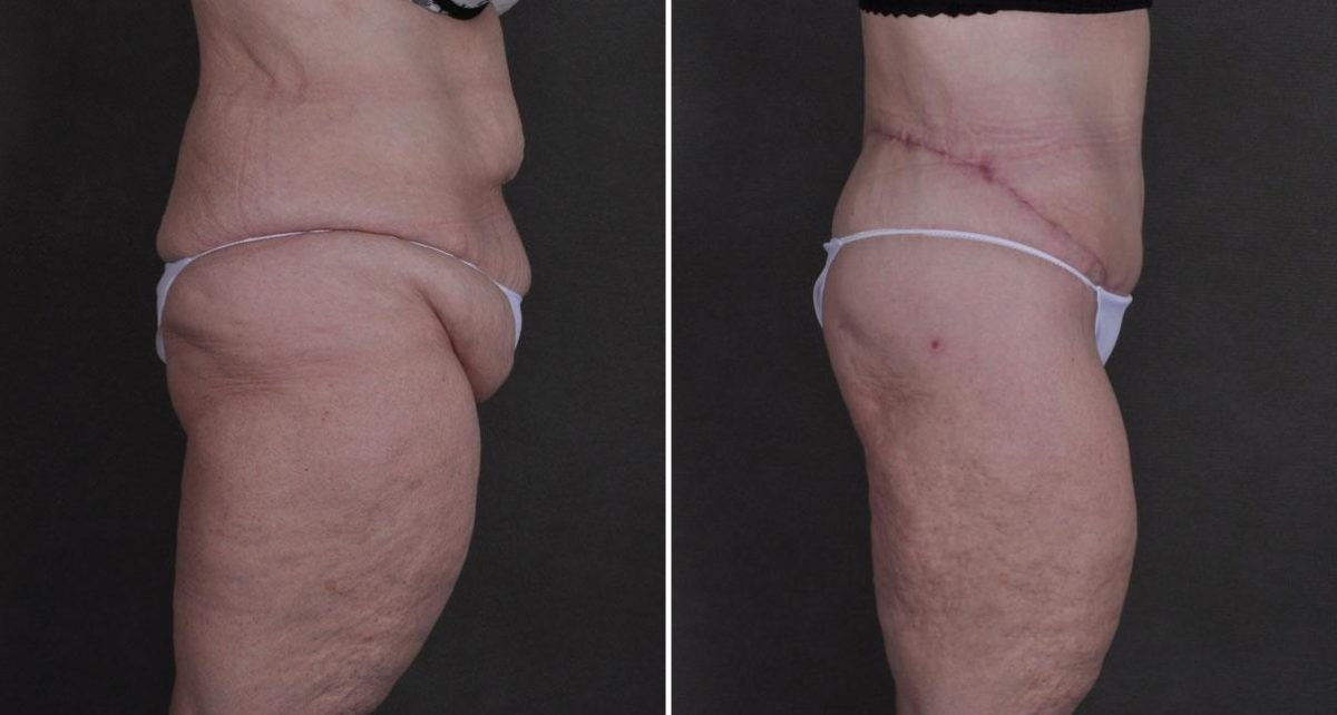 Tummy Tuck Before and After Photos in Omaha, NE, Case 8652