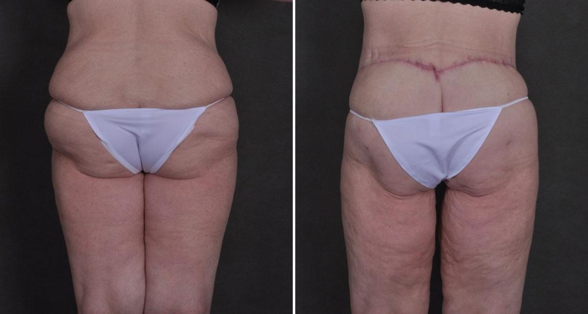 Tummy Tuck Before and After Photos in Omaha, NE, Case 8652