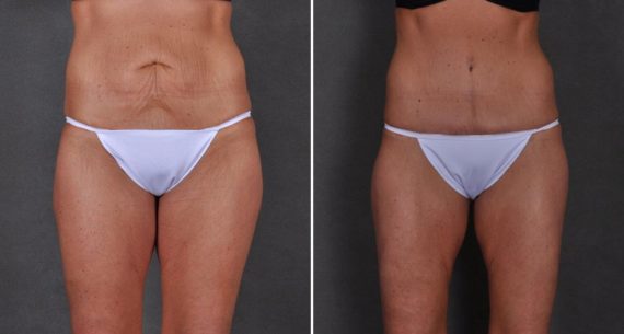 Tummy Tuck Before and After Photos in Omaha, NE, Case 8673