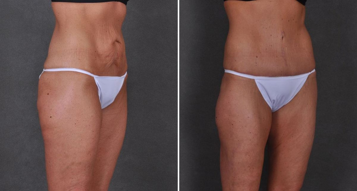 Tummy Tuck Before and After Photos in Omaha, NE, Case 8673