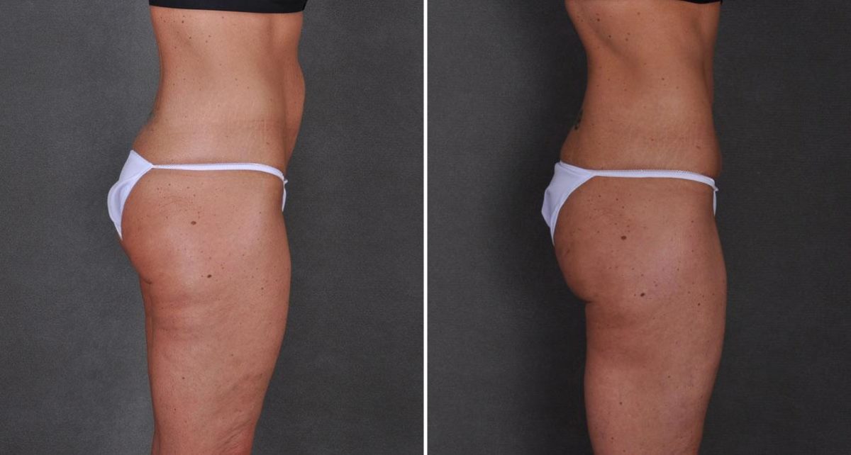 Tummy Tuck Before and After Photos in Omaha, NE, Case 8673