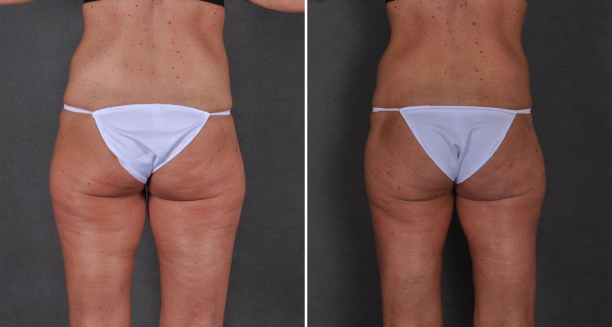 Tummy Tuck Before and After Photos in Omaha, NE, Case 8673