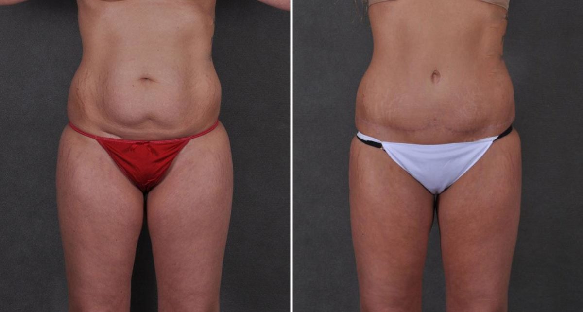 Tummy Tuck Before and After Photos in Omaha, NE, Case 8691