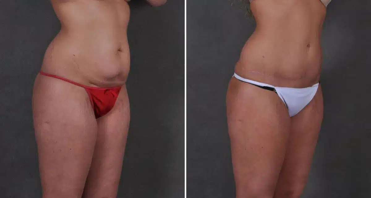 Tummy Tuck Before and After Photos in Omaha, NE, Case 8691