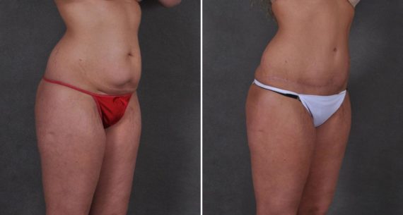 Tummy Tuck Before and After Photos in Omaha, NE, Case 8691