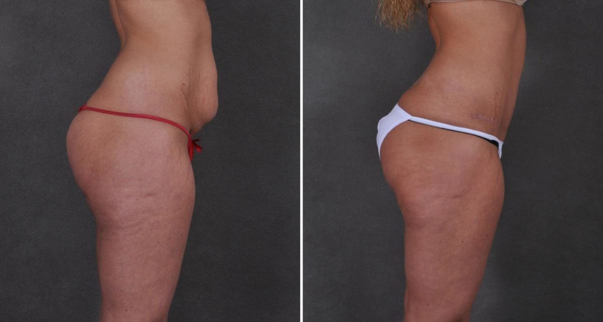 Tummy Tuck Before and After Photos in Omaha, NE, Case 8691