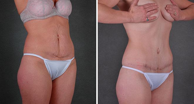 Tummy Tuck Before and After Photos in Omaha, NE, Case 7826