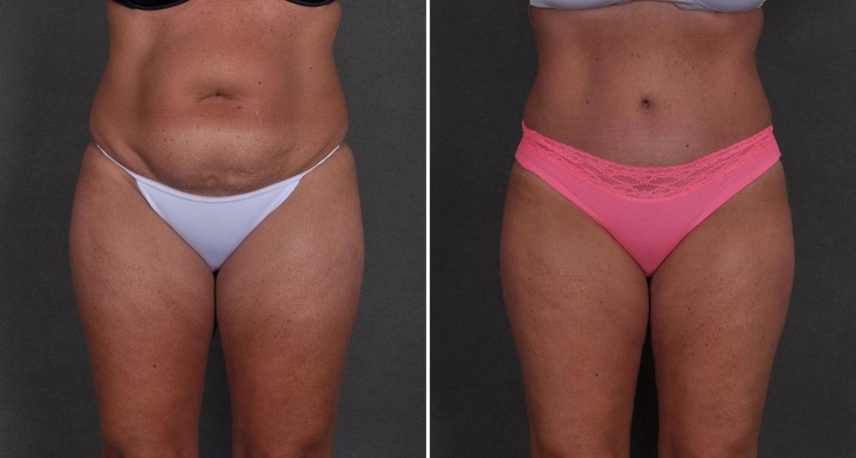 Case 8708, Tummy Tuck Before and After Photos Tummy Tuck Before and After Photos in Omaha, NE, Case 8708