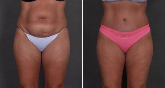 Tummy Tuck Before and After Photos in Omaha, NE, Case 8708