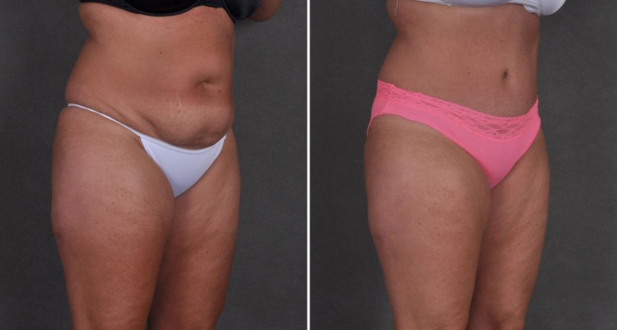 Case 8708, Tummy Tuck Before and After Photos Tummy Tuck Before and After Photos in Omaha, NE, Case 8708