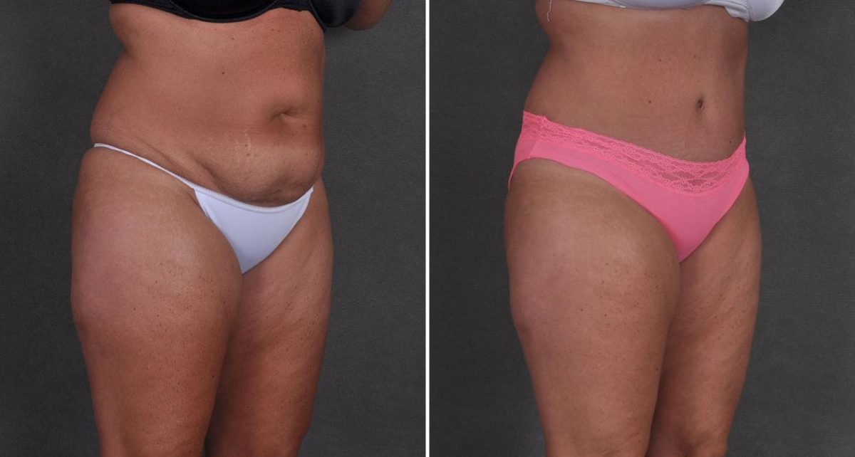 Tummy Tuck Before and After Photos in Omaha, NE, Case 8708