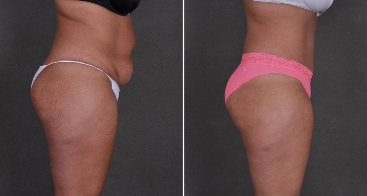 Tummy Tuck Before and After Photos in Omaha, NE, Case 8708