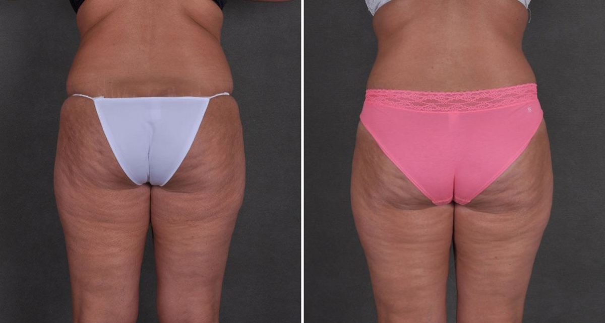 Tummy Tuck Before and After Photos in Omaha, NE, Case 8708