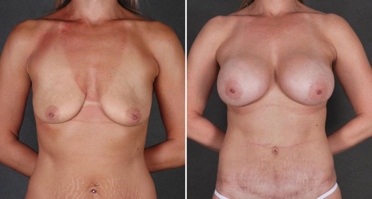 Case 8736, Tummy Tuck Before and After Photos Tummy Tuck Before and After Photos in Omaha, NE, Case 8736