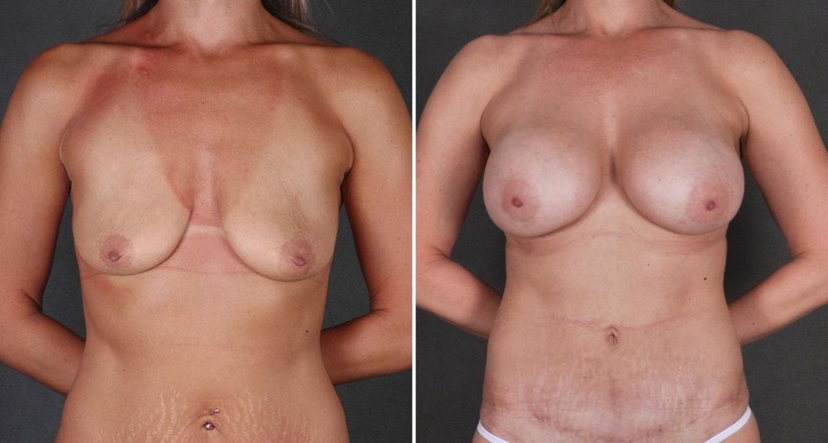 Tummy Tuck Before and After Photos in Omaha, NE, Case 8736