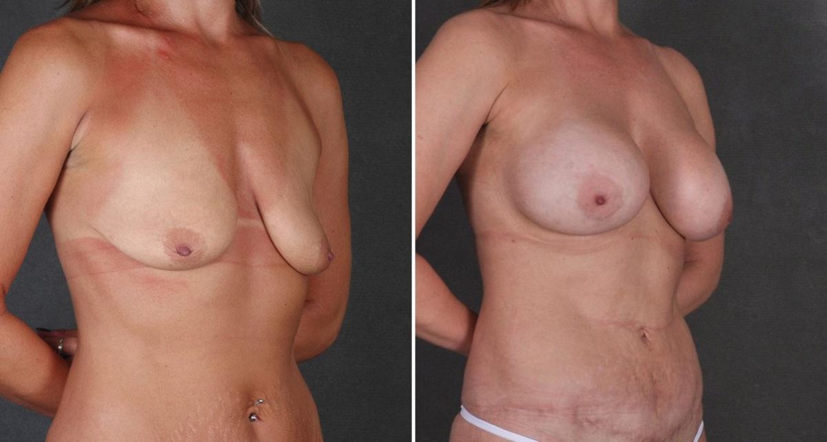 Tummy Tuck Before and After Photos in Omaha, NE, Case 8736