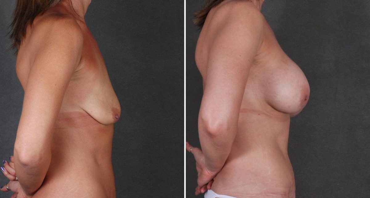 Tummy Tuck Before and After Photos in Omaha, NE, Case 8736