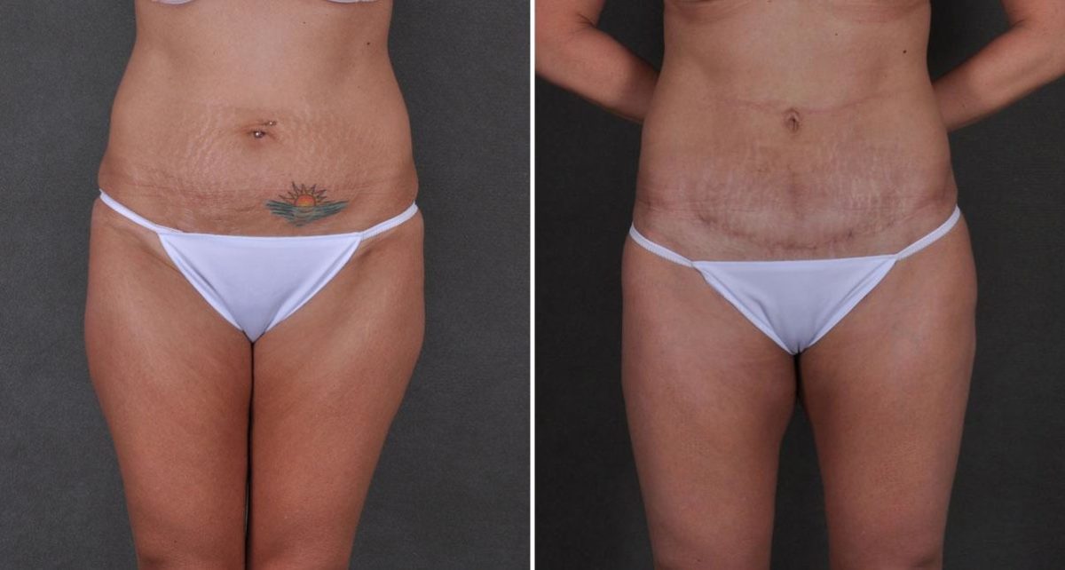 Case 8736, Tummy Tuck Before and After Photos Tummy Tuck Before and After Photos in Omaha, NE, Case 8736