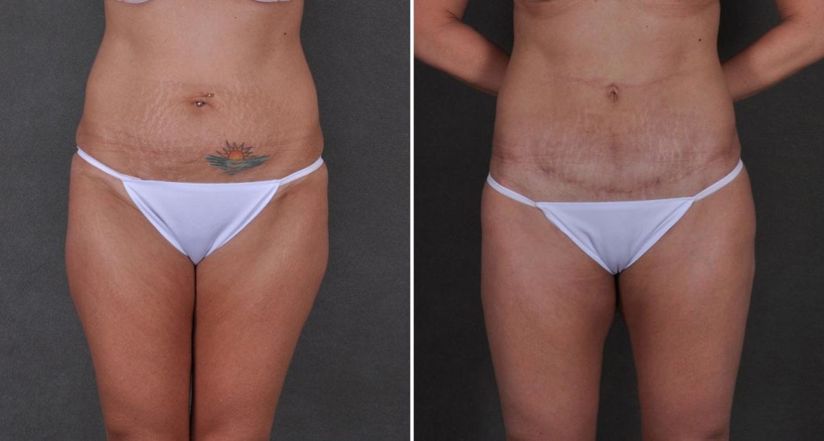 Tummy Tuck Before and After Photos in Omaha, NE, Case 8736