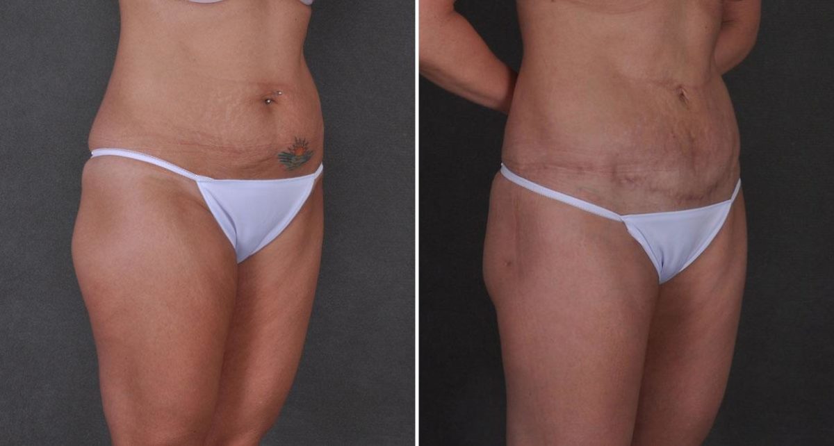 Tummy Tuck Before and After Photos in Omaha, NE, Case 8736