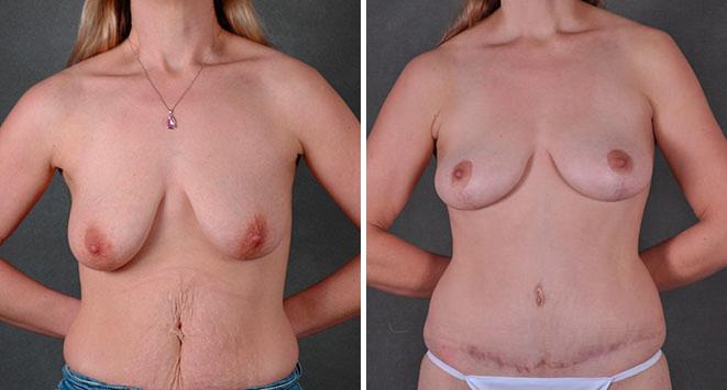 Tummy Tuck Before and After Photos in Omaha, NE, Case 7826