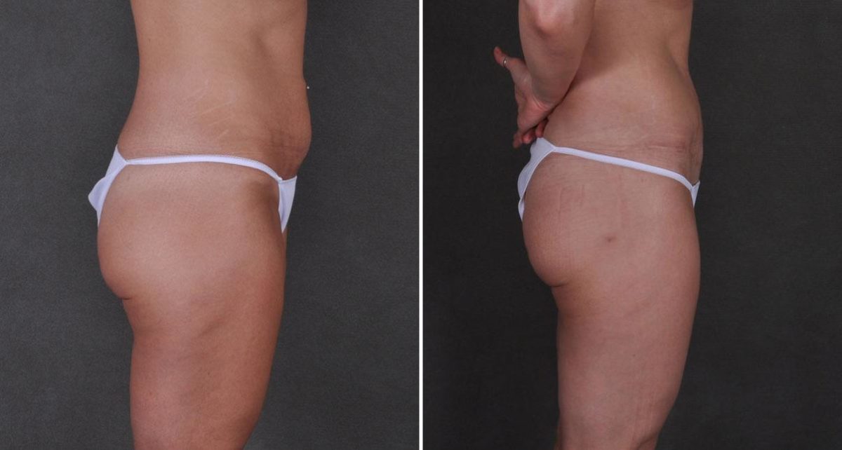 Tummy Tuck Before and After Photos in Omaha, NE, Case 8736