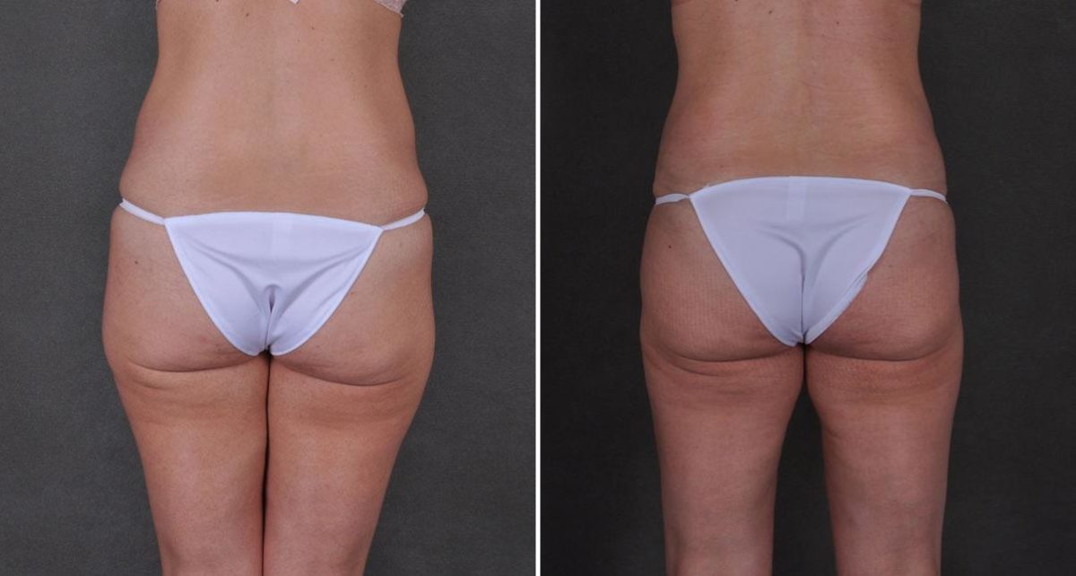 Tummy Tuck Before and After Photos in Omaha, NE, Case 8736