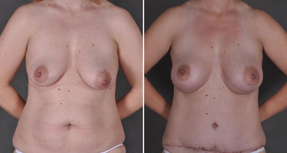 Tummy Tuck Before and After Photos in Omaha, NE, Case 8754