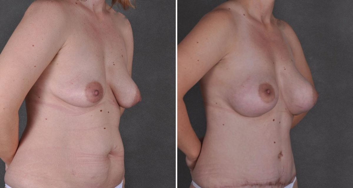 Tummy Tuck Before and After Photos in Omaha, NE, Case 8754