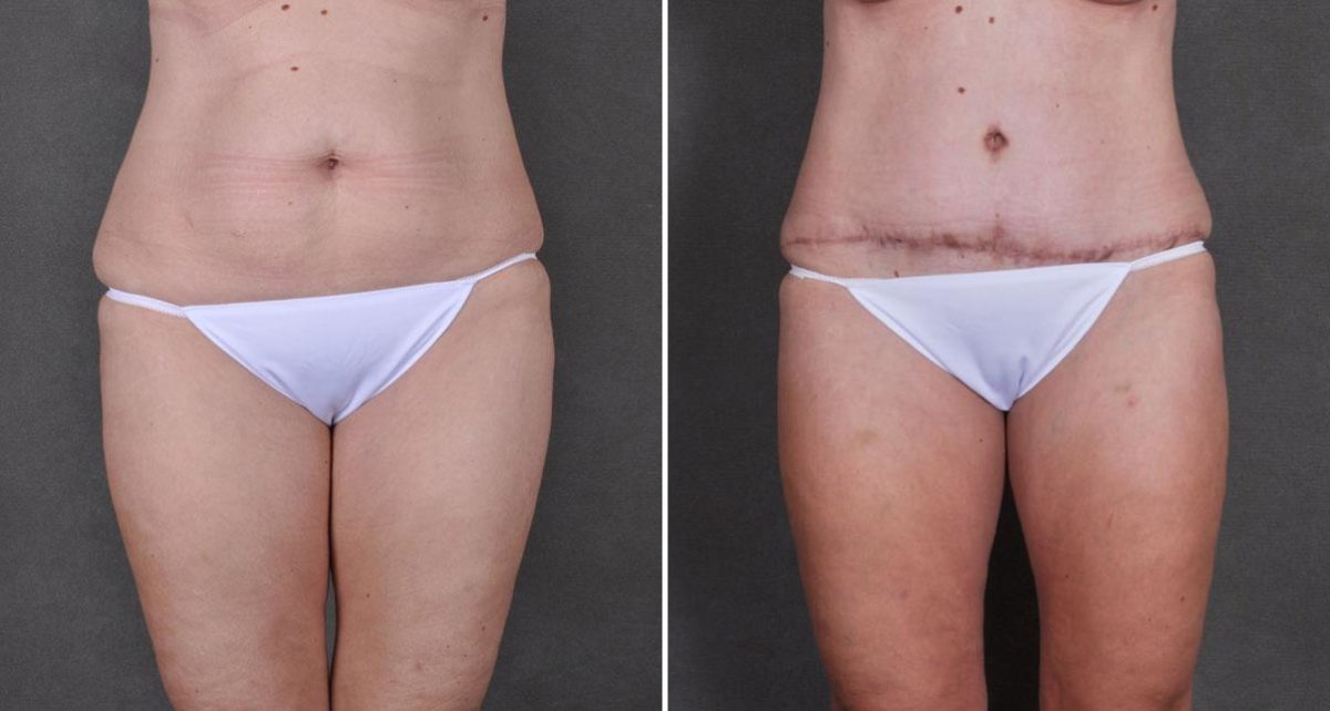 Case 8754, Tummy Tuck Before and After Photos Tummy Tuck Before and After Photos in Omaha, NE, Case 8754