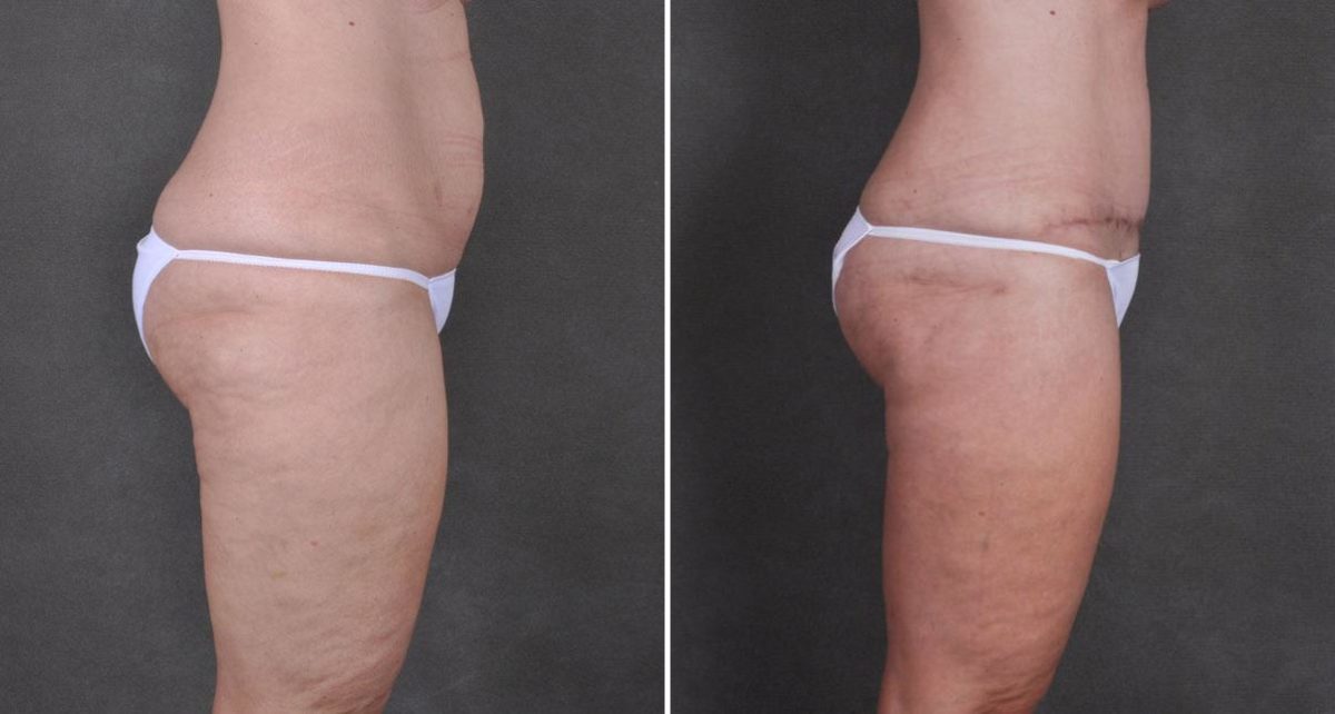 Tummy Tuck Before and After Photos in Omaha, NE, Case 8754