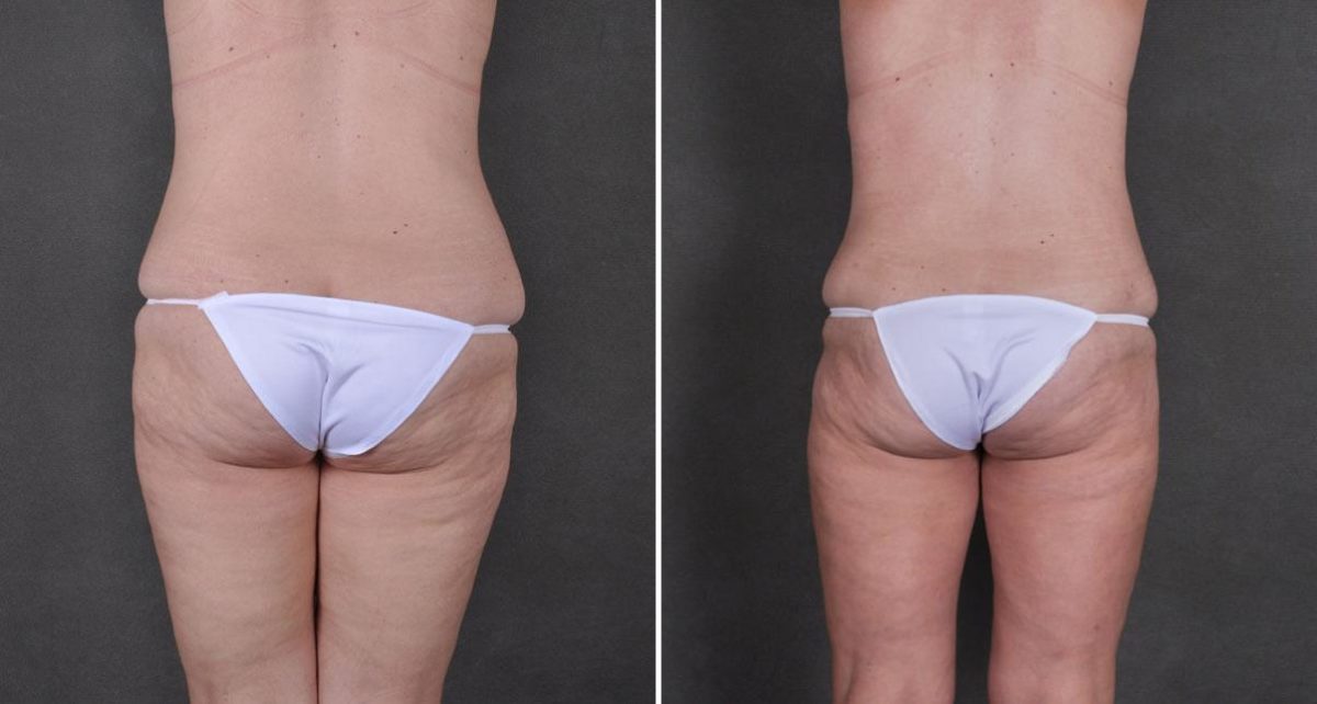 Case 8754, Tummy Tuck Before and After Photos Tummy Tuck Before and After Photos in Omaha, NE, Case 8754