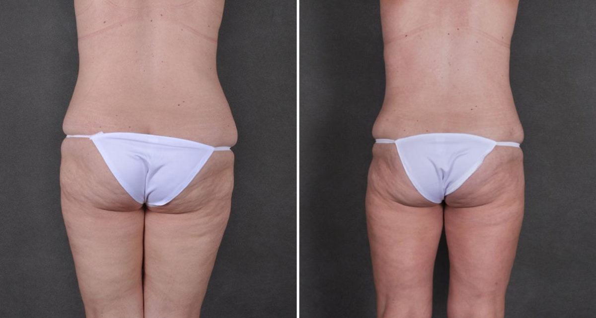 Tummy Tuck Before and After Photos in Omaha, NE, Case 8754