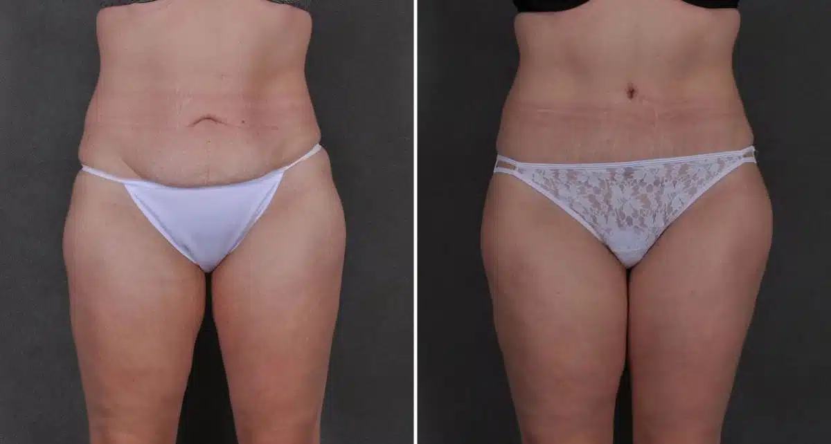 Case 8786, Tummy Tuck Before and After Photos Tummy Tuck Before and After Photos in Omaha, NE, Case 8786