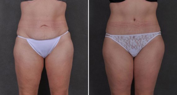 Tummy Tuck Before and After Photos in Omaha, NE, Case 8786