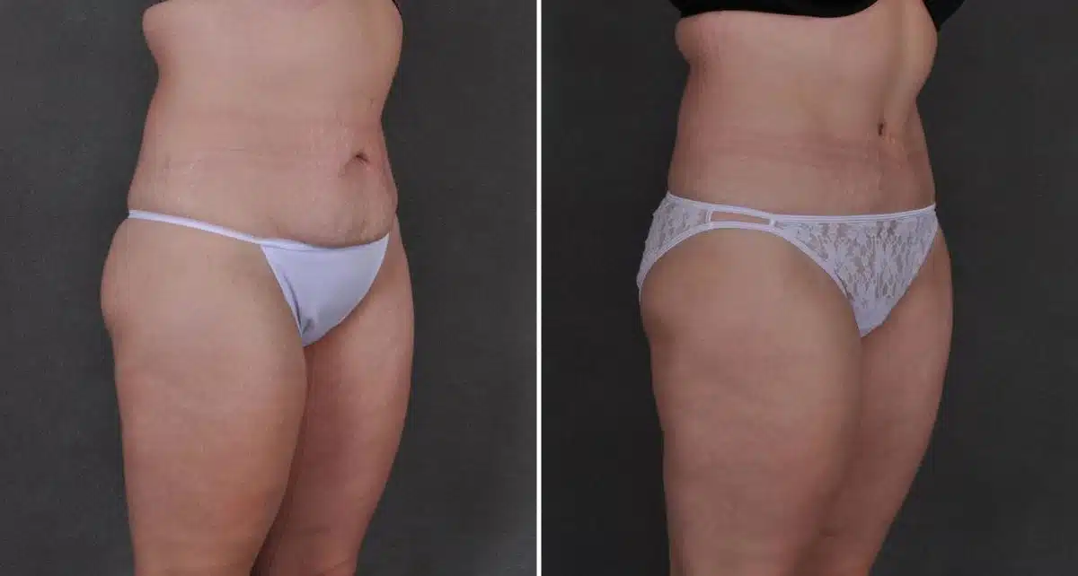 Tummy Tuck Before and After Photos in Omaha, NE, Case 8786