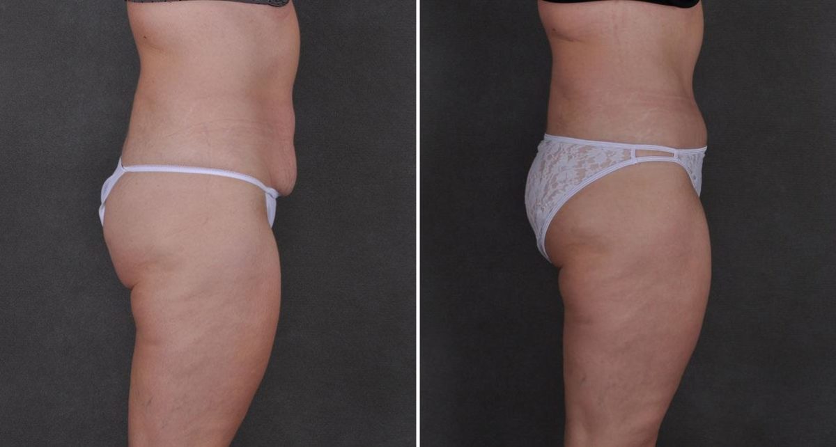 Case 8786, Tummy Tuck Before and After Photos Tummy Tuck Before and After Photos in Omaha, NE, Case 8786