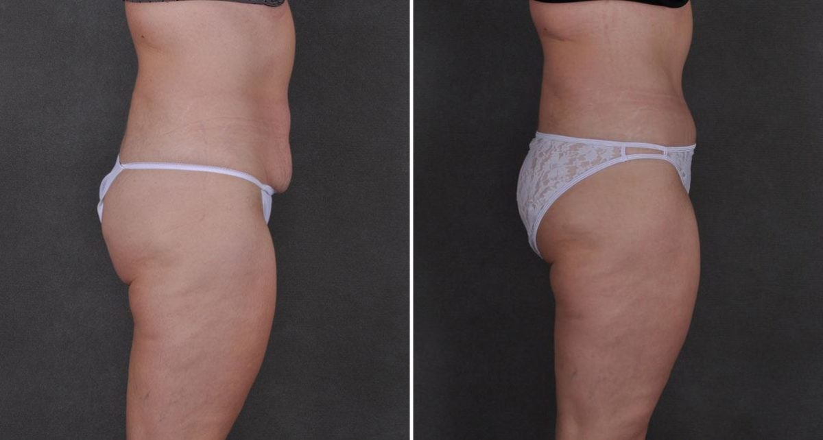 Tummy Tuck Before and After Photos in Omaha, NE, Case 8786