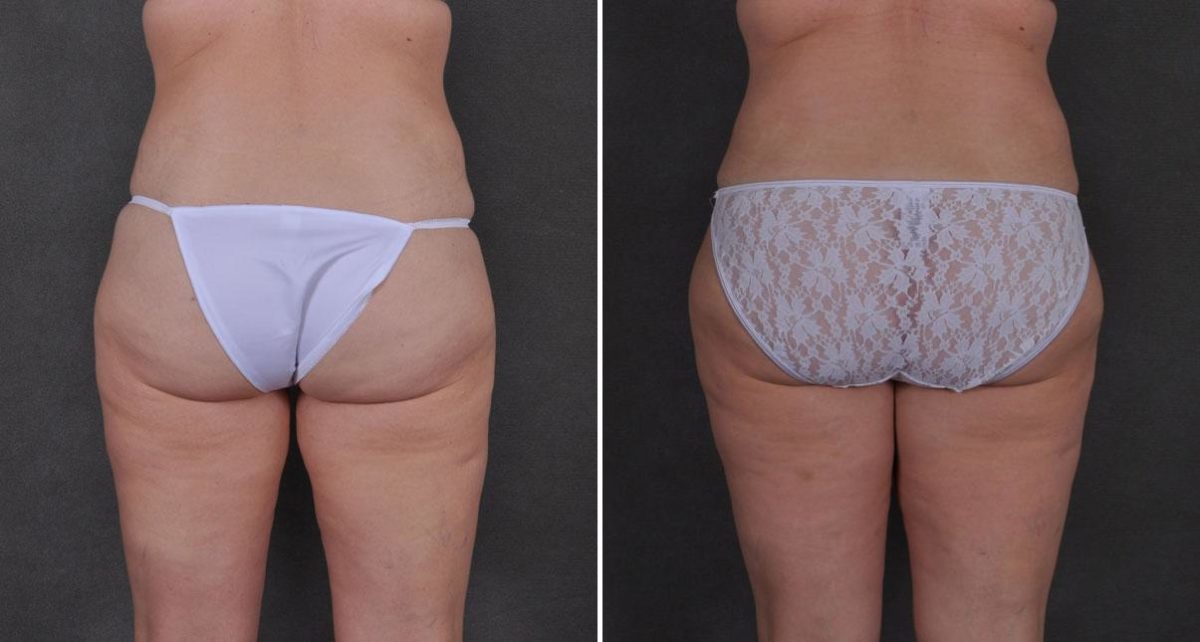 Tummy Tuck Before and After Photos in Omaha, NE, Case 8786