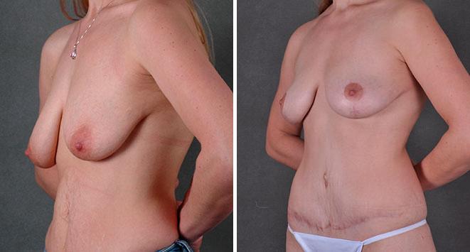 Case 7826, Tummy Tuck Before and After Photos Tummy Tuck Before and After Photos in Omaha, NE, Case 7826