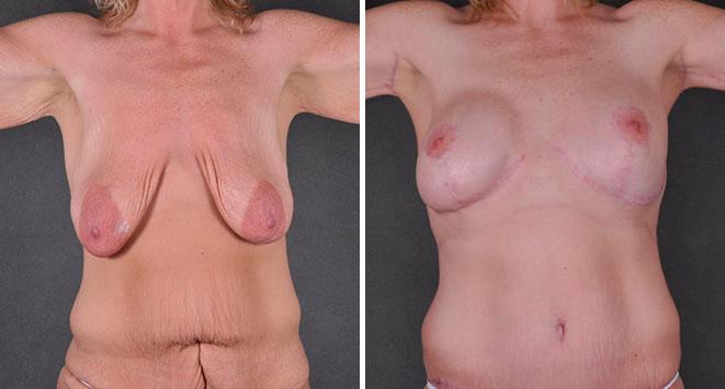 Case 7888, Tummy Tuck Before and After Photos Tummy Tuck Before and After Photos in Omaha, NE, Case 7888