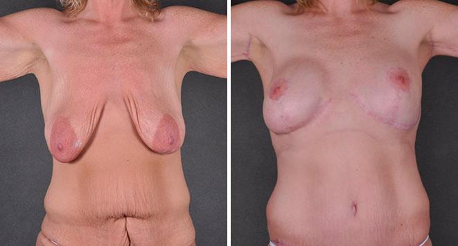 Tummy Tuck Before and After Photos in Omaha, NE, Case 7888