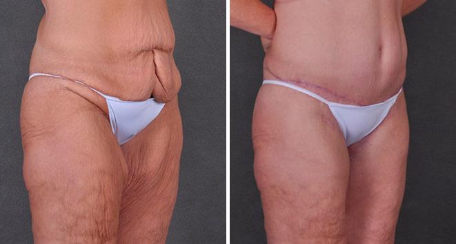Case 7888, Tummy Tuck Before and After Photos Tummy Tuck Before and After Photos in Omaha, NE, Case 7888