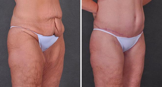 Tummy Tuck Before and After Photos in Omaha, NE, Case 7888