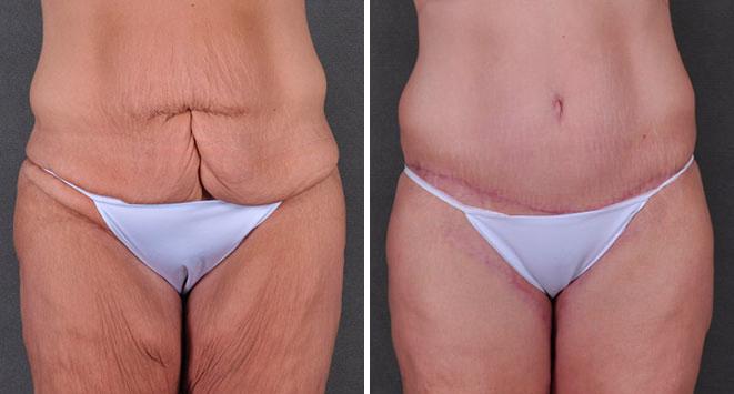 Case 7888, Tummy Tuck Before and After Photos Tummy Tuck Before and After Photos in Omaha, NE, Case 7888